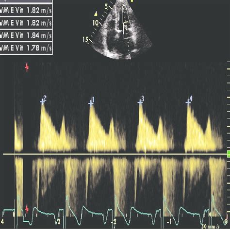 Mesures répétées du pic de la vitesse transmitrale Vmax en Doppler