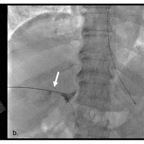 Using Ultrasound Guidance A 22 Gauge Needle Arrow Was Placed At The