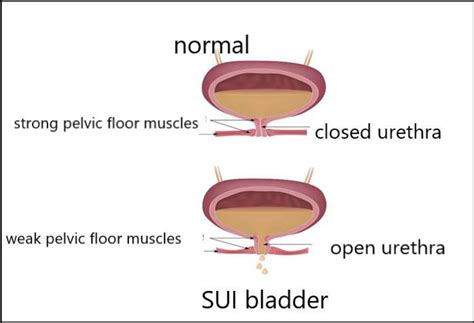 Normal Bladder And Stress Urinary Incontinence Bladder Download