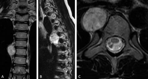 Figure 1 A Novel Endoscopic Technique For Biopsy And Tissue Diagnosis For A Paraspinal