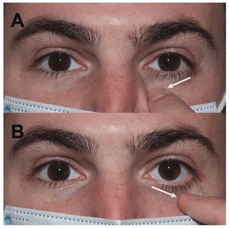 Eyelid Lacerations Anesthesia Key