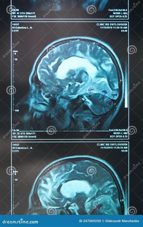 A Fragment Of An Image Of An Elderly Person S Brain Scan On Magnetic