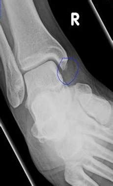 Medial Malleolus Ossicle - Sumer's Radiology Blog