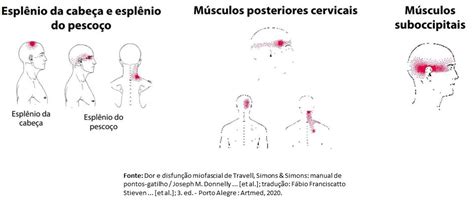 Infiltração de pontos gatilhos musculares Dr Paulo Faro