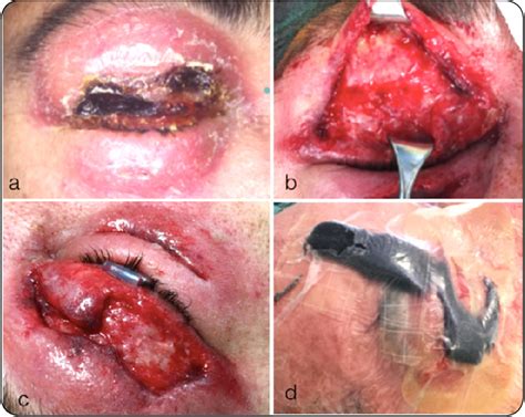 Figure 1 From Current Trends In Ophthalmology Management Of Periorbital