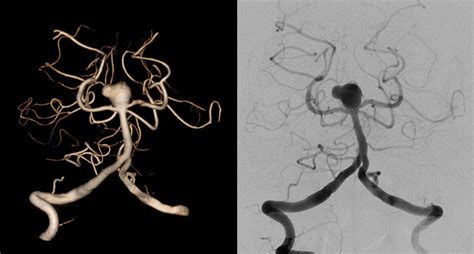 O que você precisa saber sobre Aneurisma Cerebral Neocure