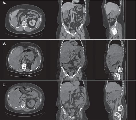 Figure 1 From A Case Report Of Severe Type B Lactic Acidosis Following First Dose Of Nivolumab