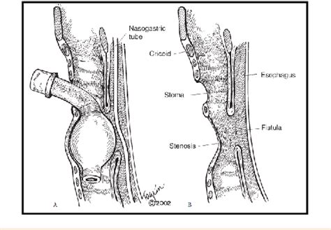 Figure 1 From Tracheoesophageal Fistula A Complication Of Prolonged