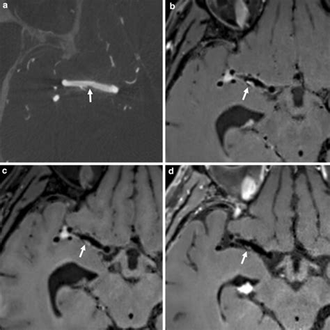 A Year Old Man With Middle Cerebral Artery Dissection Indicated As