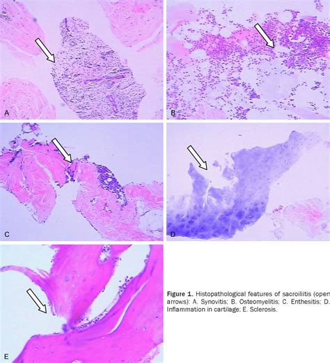 Figure 1 From The Relationship Between Histopathological And Imaging Features Of Sacroiliitis