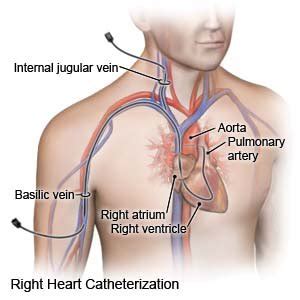 Right Heart Catheterization (Discharge Care)