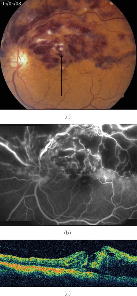 Figure 1 From Macular Hole Progression After Intravitreal Bevacizumab