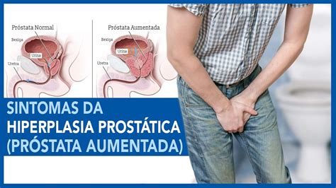 Sintomas da Hiperplasia Prostática Próstata Aumentada YouTube