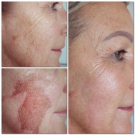 Plasma Fibroblast Lift Skin Tightening In Southfield Mi Pigalle Medspa