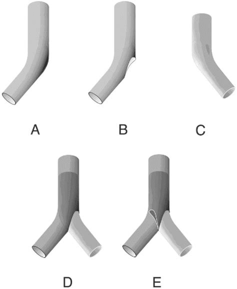 Kissing Stent Reconstruction Of The Aortoiliac Bifurcation Semantic