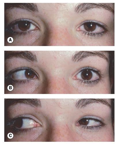 Strabismus Other Flashcards Quizlet