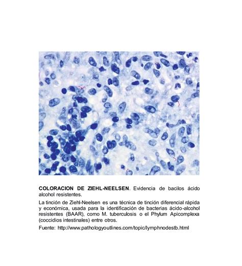 Tuberculosis Ganglionar Axilar Pdf