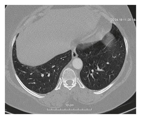 A Chest Computed Tomography Ct Scans Transverse Plane Of The Download Scientific Diagram