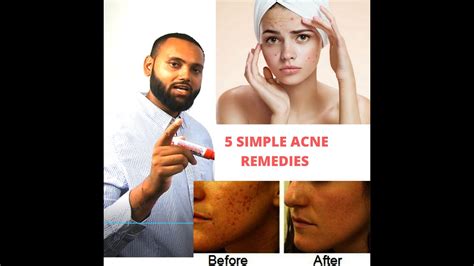 5 Secrets To Get Rid Of Acne Permanently Simple Acne Remedies Youtube