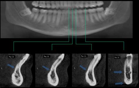 Caso N Fractura Mandibular Cdi Per