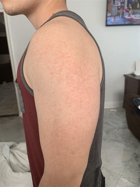 [Skin Concerns] How can I treat these bumps all around both of my arms? : r/SkincareAddiction