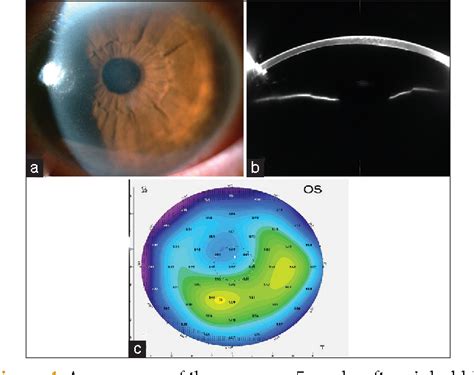 Figure 4 From Complex Descemet S Membrane Tears And Detachment During Phacoemulsification