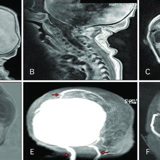 (A) T1-weighted magnetic resonance imaging (MRI) noting the large ...