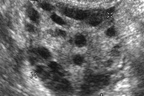 Antral Follicle Count | Fertility medications, Ovarian follicle, Clomid