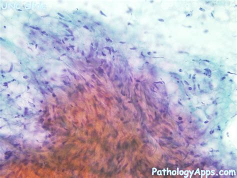 leiomyosarcoma soft tissue cytology