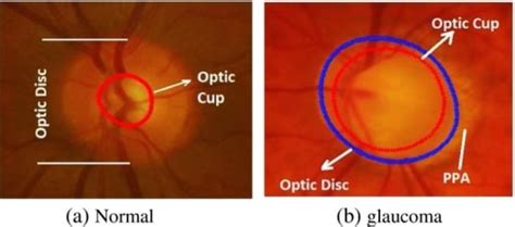 Glaucoma Concise Medical Knowledge