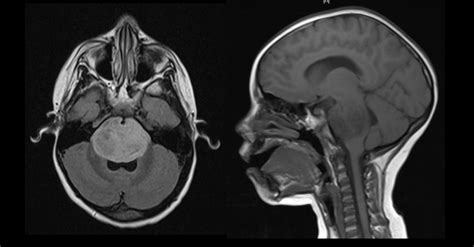 Assessing pediatric brain tumors - Boston Children's Discoveries