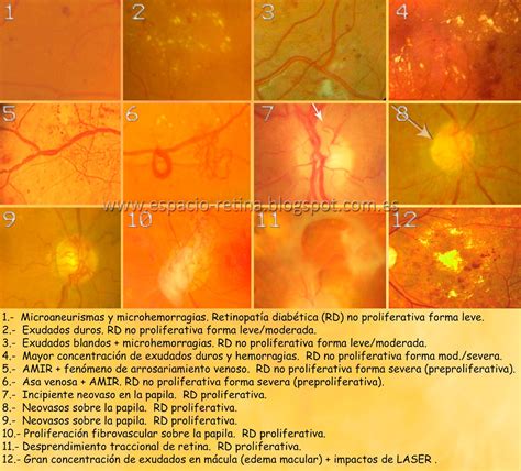 Espacio Retina Retinopat A Diab Tica Cronopatolog A