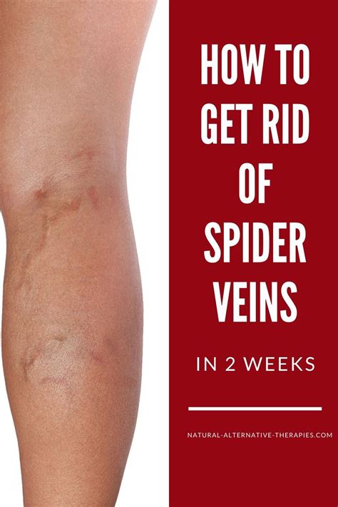 How To Get Rid Of Spider Veins Naturally In 2 Weeks Get Rid Of Spider Veins Spider Veins