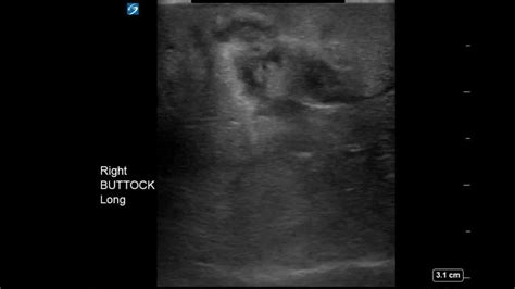 Buttocks Ultrasound Phlegmon Youtube