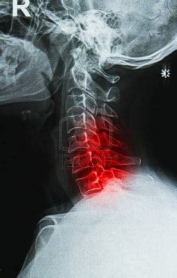 16418756-x-ray-image-of-the-painful-or-injury-cervical-bone-c-spine ...