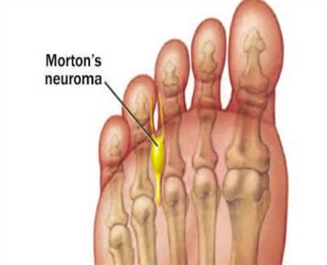 Neuroma Coquitlam Podiatry Foot And Ankle Clinic Coquitlam Vancouver