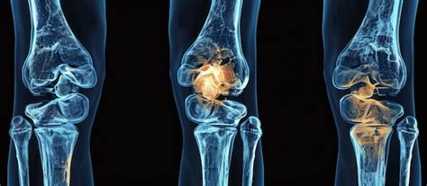 Detailed Xray Images Of Human Knee Joints Affected By Arthritis