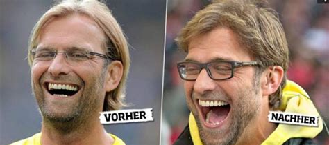 Jürgen Klopp Hair Transplant | Sapphire Hair Clinic