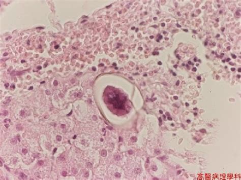 Kmu Pathology Labslide Schistosomiasis Liver