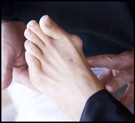 Bunions Feet Treatment Review: Types of Bunions Feet