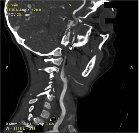 Sagittal CT Angiogram Demonstrating A Perfusion Deficit Of The Right