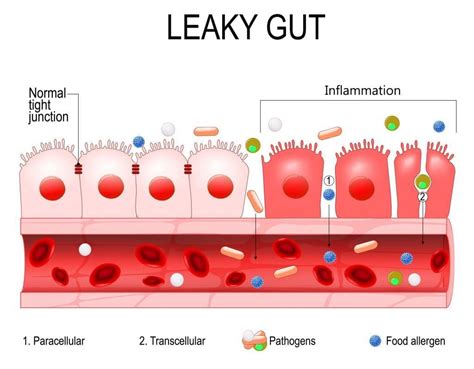 Leaky Gut Syndrome Symtoms And Treatment With Ibs Clinics