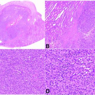 Photomicrographs Of The Tumor A Wholemount Showing Cross Section Of