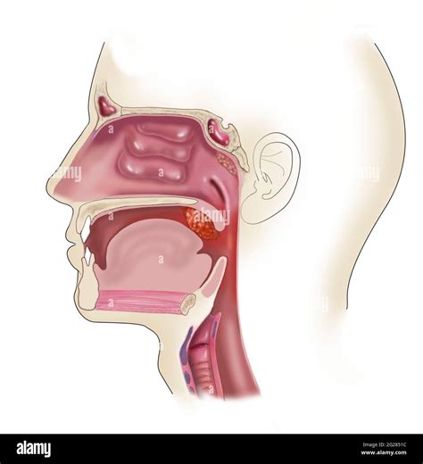 Tonsils hi-res stock photography and images - Alamy