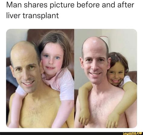 Man Shares Picture Before And After Liver Transplant IFunny