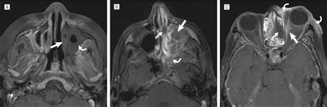 Computed Tomography And Magnetic Resonance Imaging Characteristics Of Acute Invasive Fungal