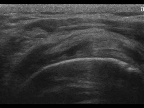 Musculoskeletal Joints and Tendons | 6.1 Shoulder : Case 6.1.12 Rotator ...