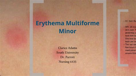 Erythema Multiforme Major Vs Minor