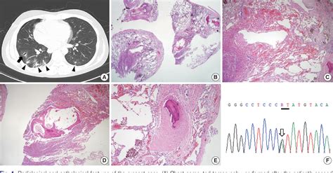 Figure 1 From Vascular Ehlers Danlos Syndrome With Distinct