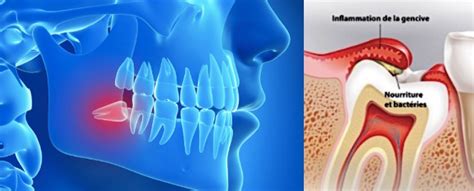 Dents De Sagesses Dr John Vigneron Proche D Yverdon